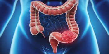 Morre Preta Gil: câncer colorretal se torna ameaça precoce e global