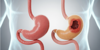 Cuidar do Estômago é Cuidar da Vida: O Que Você Precisa Saber sobre Úlceras